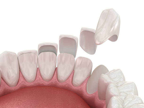 Dental veneers